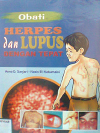 OBATI HERPES DAN LUPUS DENGAN TEPAT